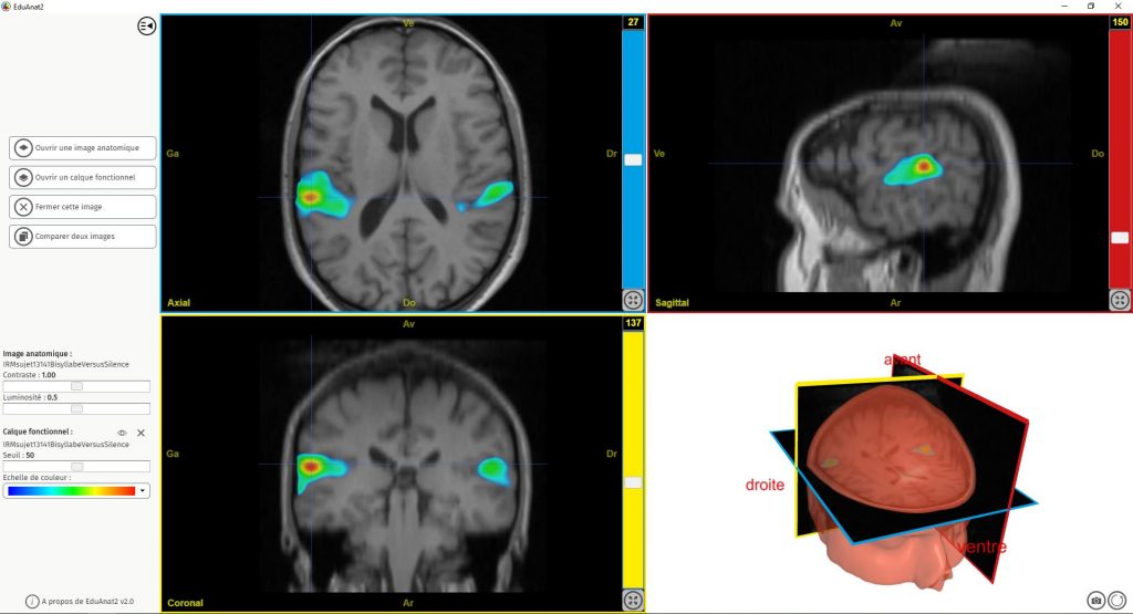 Capture d'écran d'EduAnat2 montrant une IRMf associée à l'audition d'un son