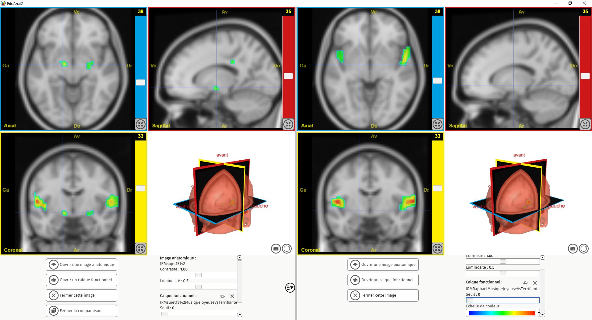 Utiliser ÉduAnat2 pour mettre en évidence les aires cérébrales ...