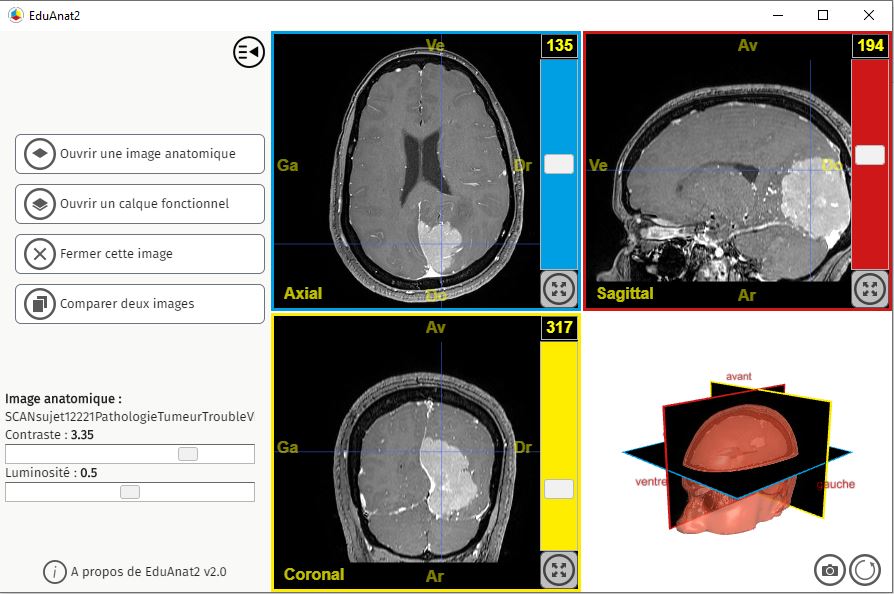 Capture d'écran du logiciel EduAnat2 montrant une tumeur située dans le lobe occipital