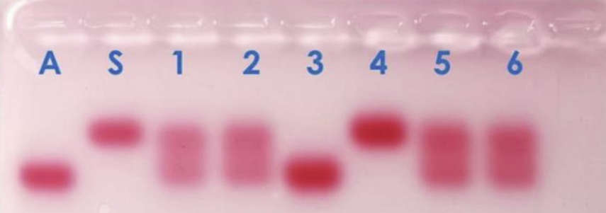 Gel obtenu avec d'authentiques solutions d'hémoglobine, révélées au rouge Ponceau.(source Sordalab)